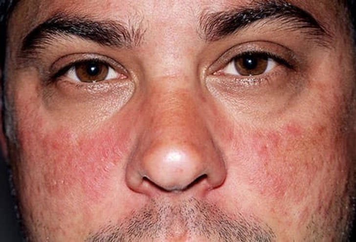 Lupus Lupus