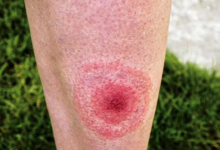 Lyme Disease