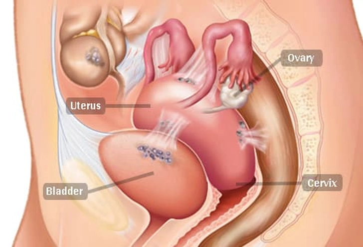Endometriosis Endometriosis