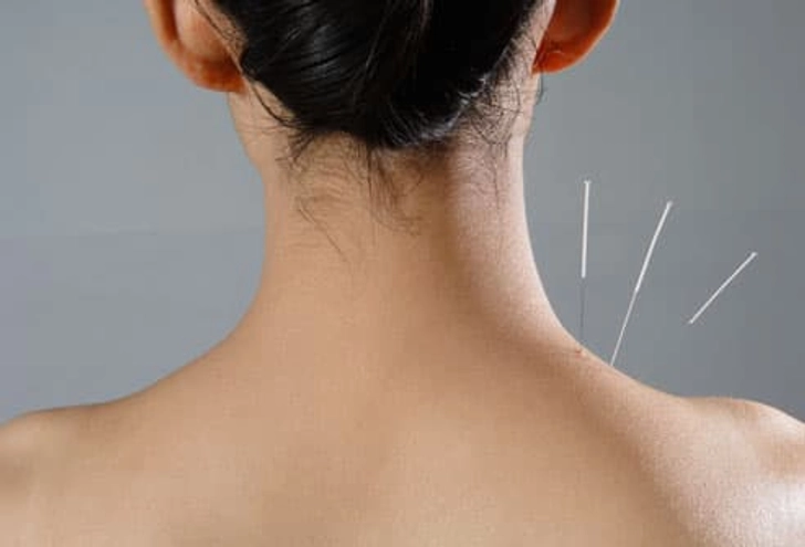 Give Acupuncture a Chance