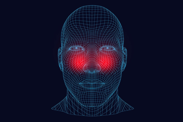 Sinus Headaches Sinus Headaches