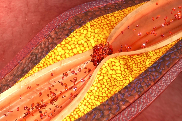 Keep Cholesterol in Check
