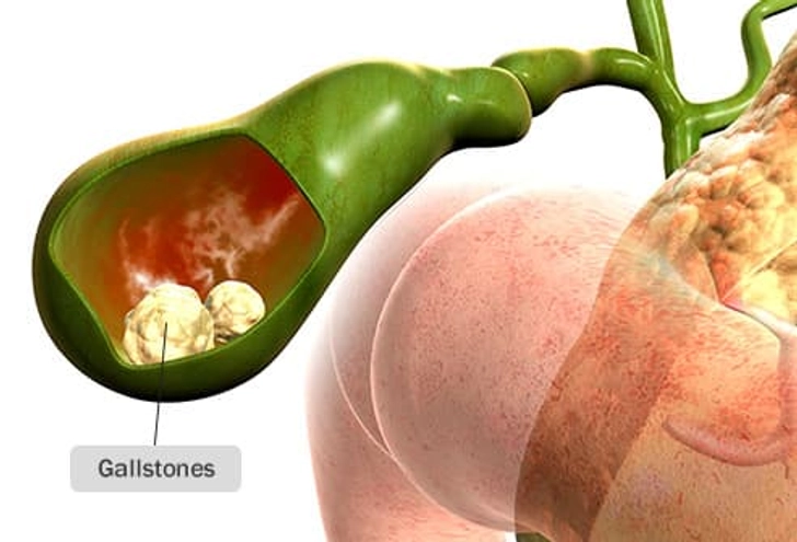 Gallstones