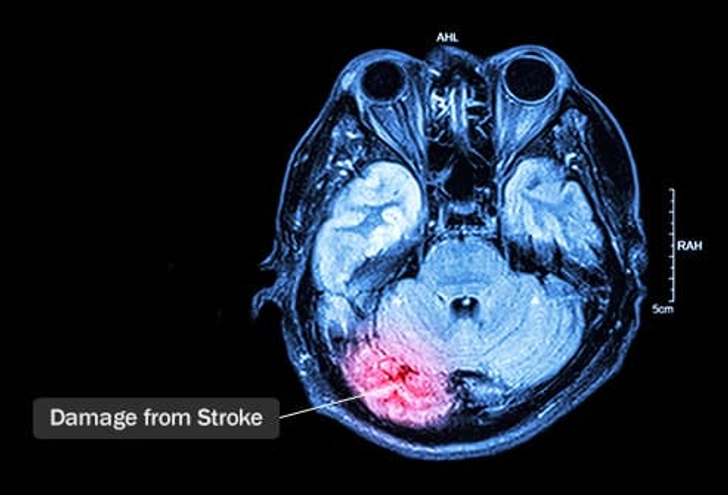 Stroke