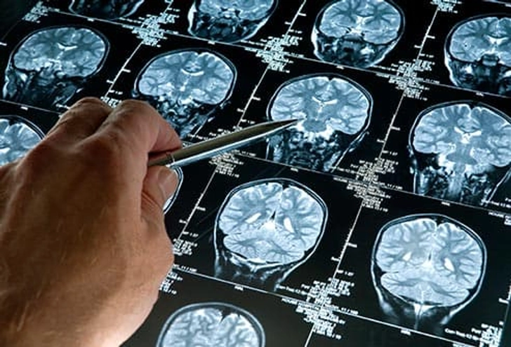 Alzheimer’s Disease
