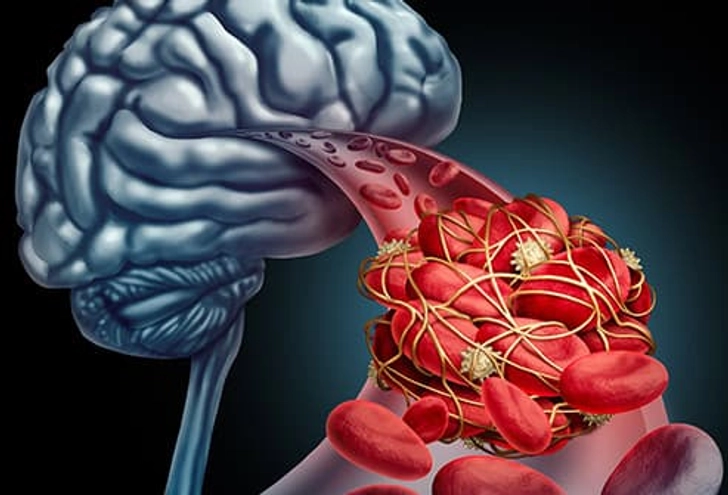 They Can Lower Your Odds of a Stroke They Can Lower Your Odds of a Stroke