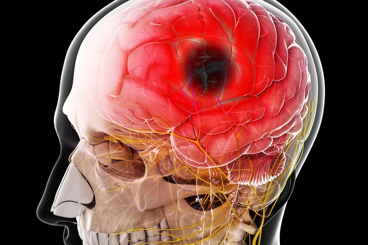 Lowers Stroke Risk Lowers Stroke Risk