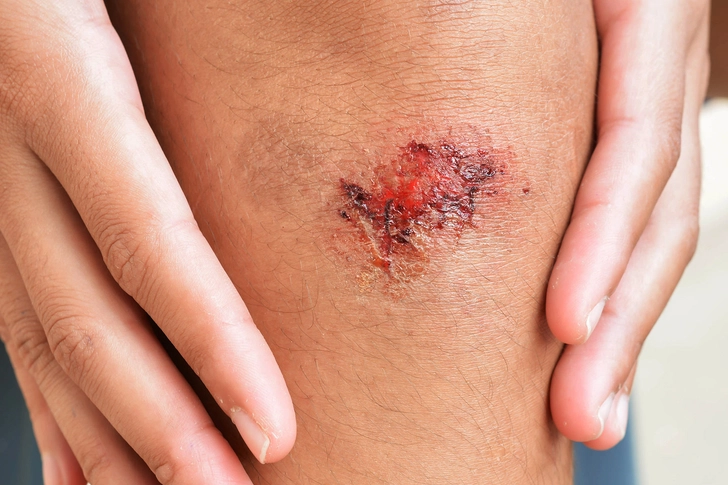Wound Recovery Wound Recovery