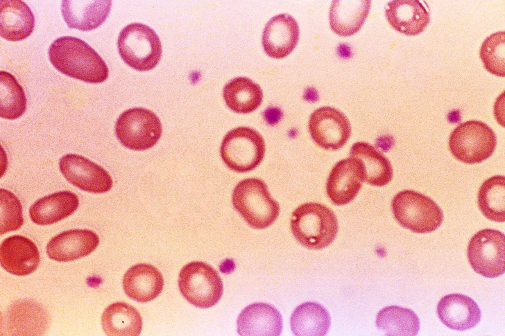 Cuts Risk of Iron Deficiency Anemia Cuts Risk of Iron Deficiency Anemia