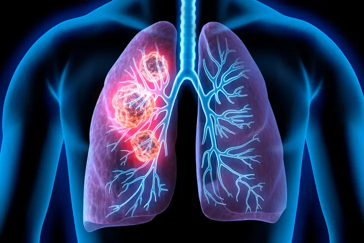 Lung Cancer