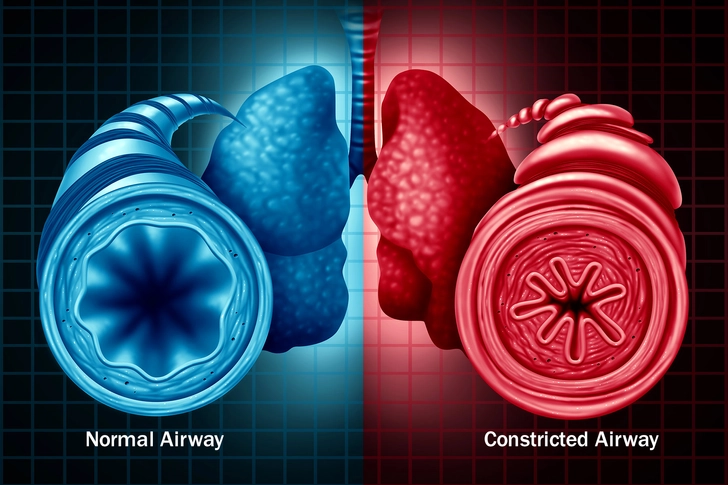 COPD