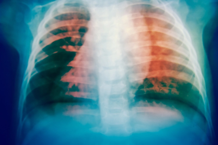 Pneumonia