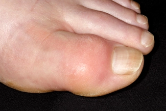 Gout Gout