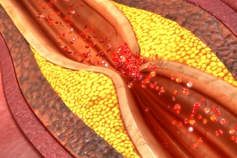 Hardened Arteries Hardened Arteries