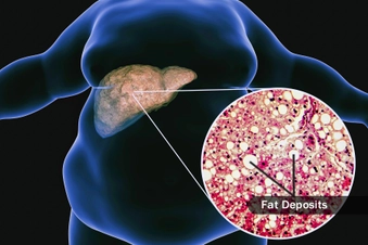 Metabolic Dysfunction-Associated Steatotic Liver Disease (MASLD) Metabolic Dysfunction-Associated Steatotic Liver Disease (MASLD)