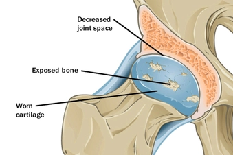 Osteoarthritis Osteoarthritis