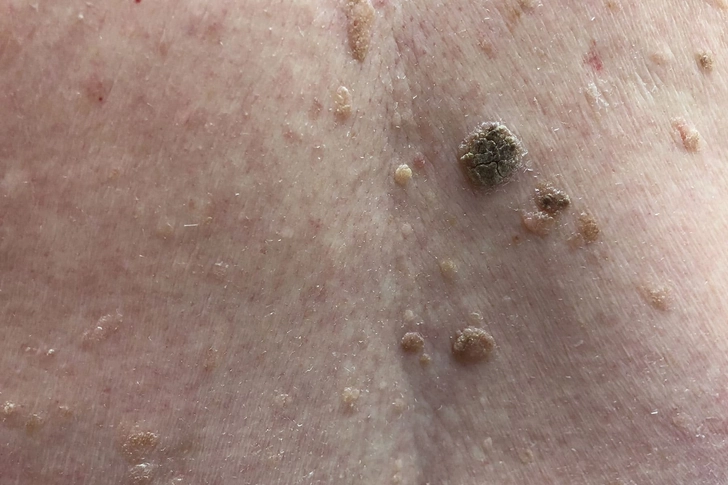 Seborrheic Keratoses Seborrheic Keratoses