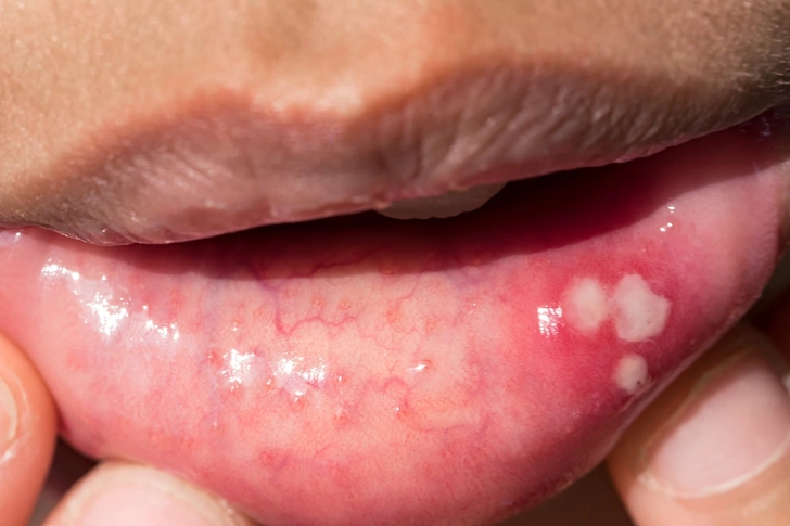 Canker Sores Canker Sores