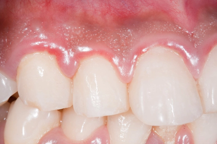 Swollen Gums