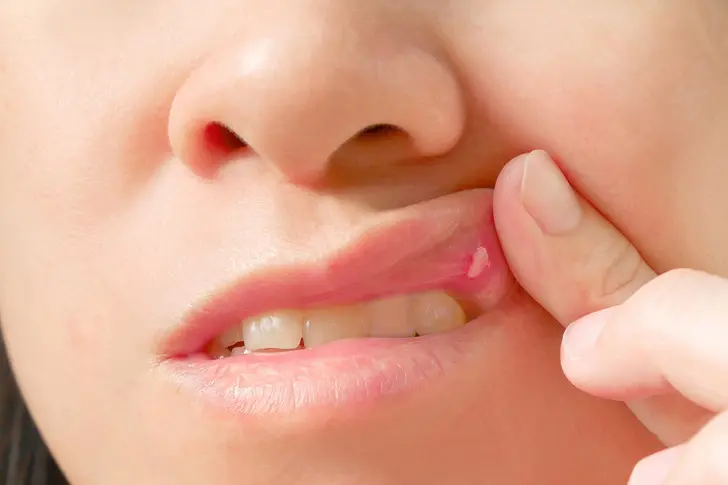 Canker Sores