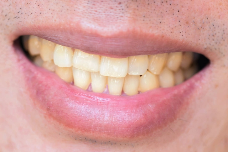 Teeth Stains Teeth Stains
