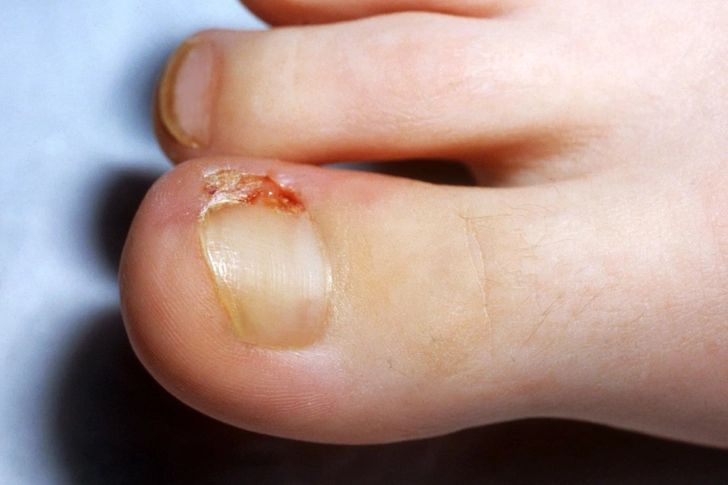 Ingrown Toenail