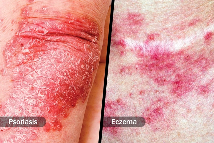 Psoriasis and Eczema Psoriasis and Eczema