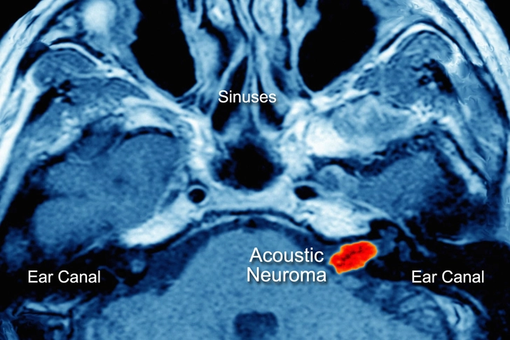 Tumors and Growths