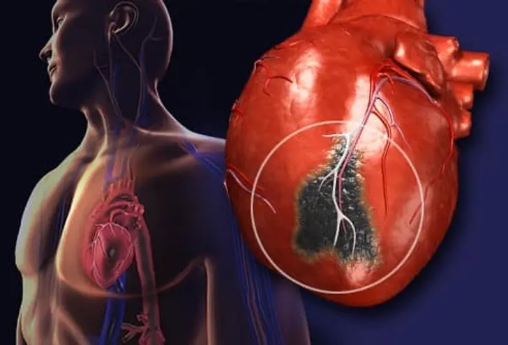 Visual Guide To Heart Attacks