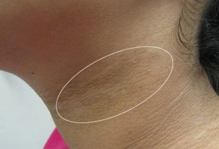 Dark, Velvety Skin Patches