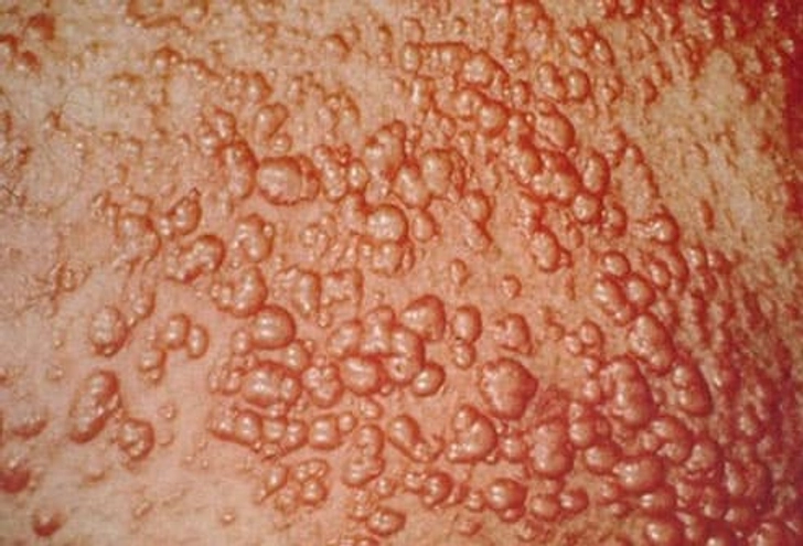 Yellow-Orange Bumpy Rash