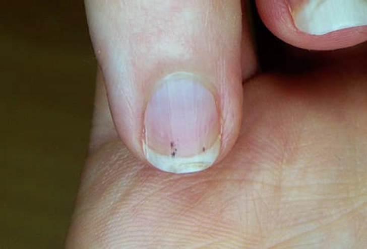 Dark Spot Under Nails Dark Spot Under Nails