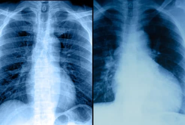 Chest X-rays