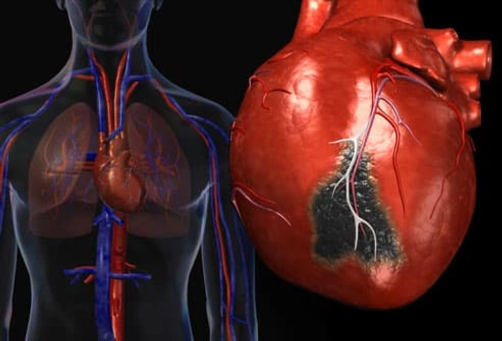 Inside a Heart Attack Inside a Heart Attack
