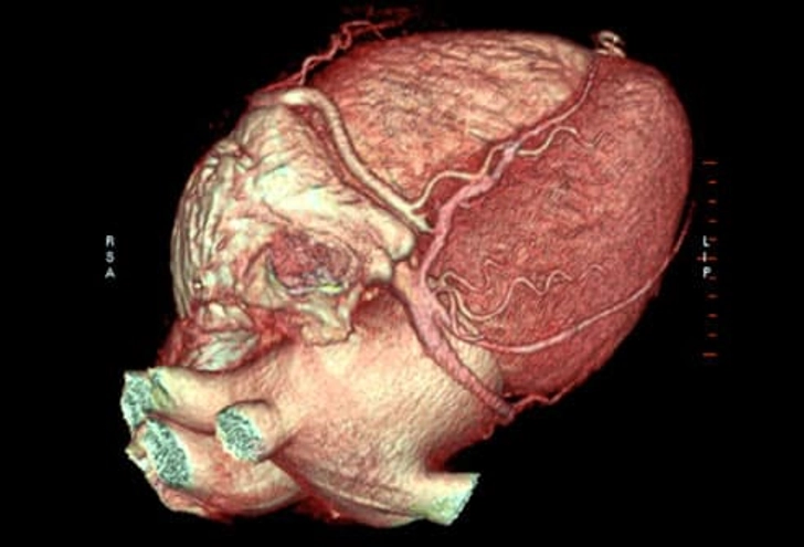 Cardiac CT