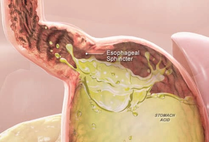 Heartburn: Faulty Valve