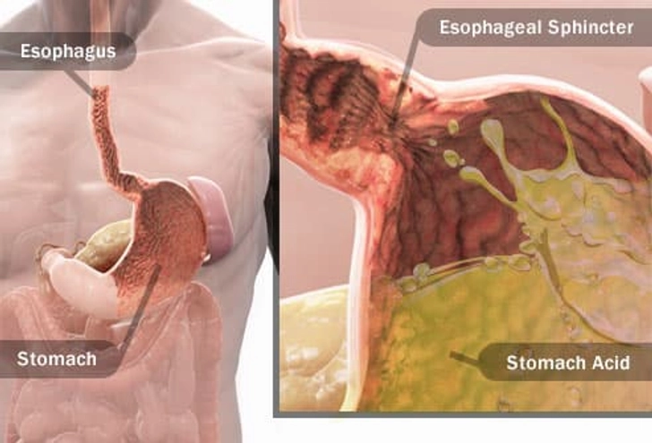Heartburn: An Inside Look
