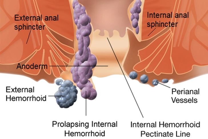 Prolapse and Thrombosis