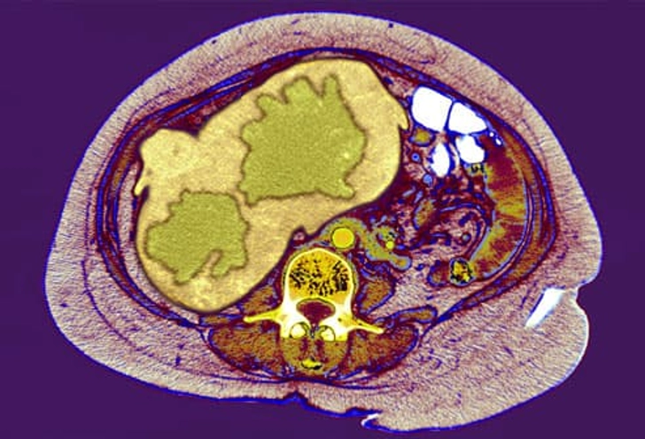 Complications: Liver Cancer