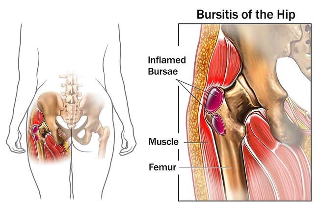 Bursitis Bursitis