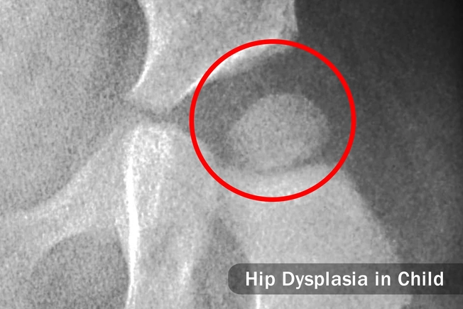 Dysplasia Dysplasia
