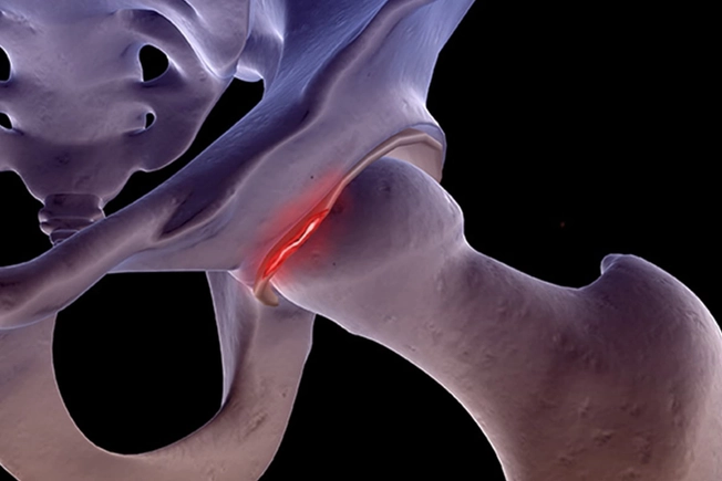 Labral Tear Labral Tear
