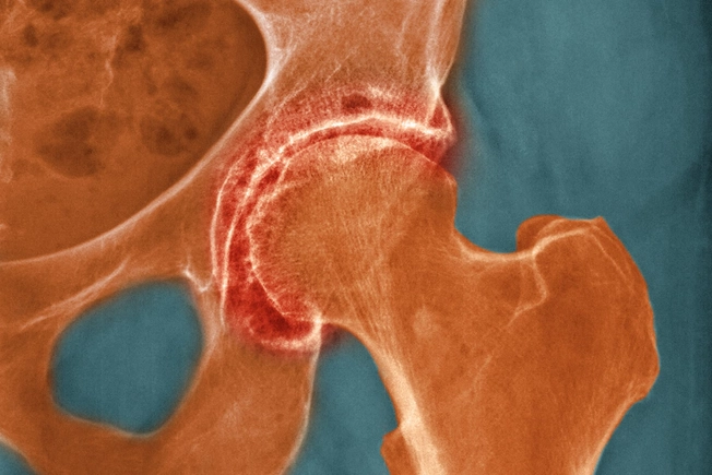 Osteoarthritis Osteoarthritis