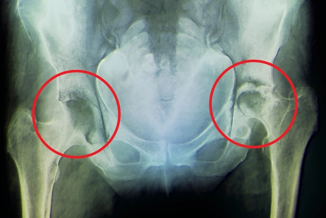 Rheumatoid Arthritis