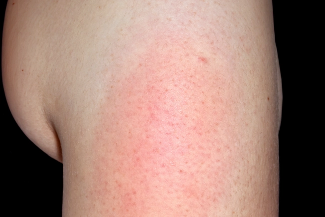 Injection Site Reactions Injection Site Reactions