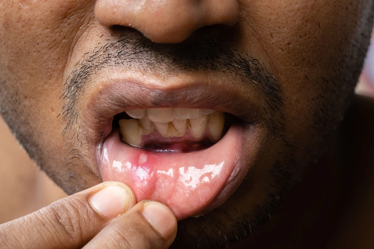 Mouth Sores Mouth Sores