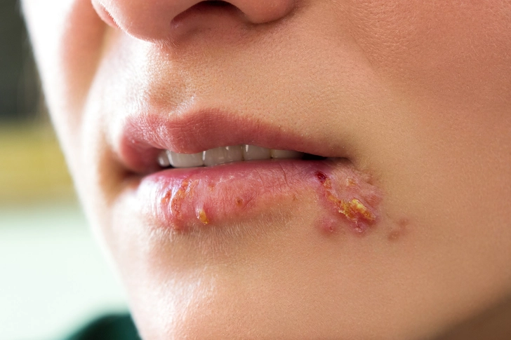 Herpes Herpes