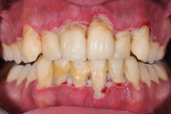 Bone Loss Bone Loss