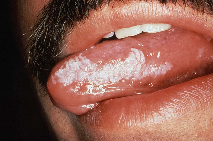 Hairy Leukoplakia