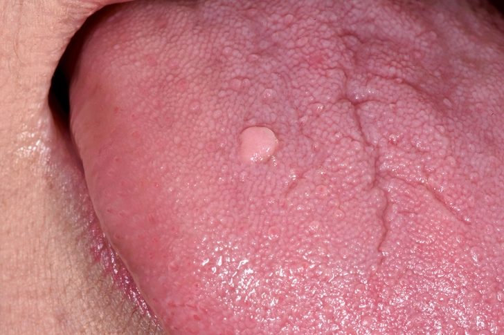 Warts Warts